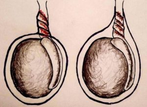 Увеличилось левое яичко