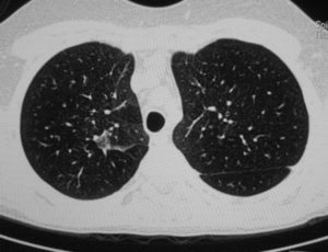 КТ грудной клетки. Астма или нет?