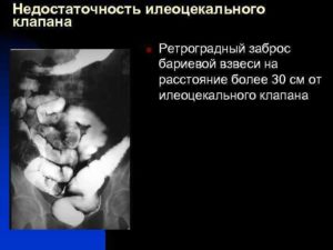 Недостаточность илеоцекального клапана