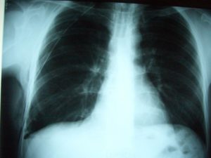 Спайки после пневмонии