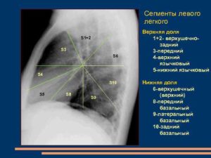 Очаг в сегменте S10 левого легкого