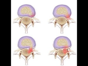 Секвестрированная грыжа