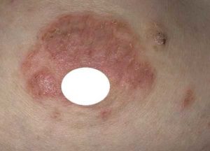 Коричневая корочка на соске, покалывания