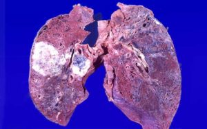 Онкология легких Помогите понять результат 7