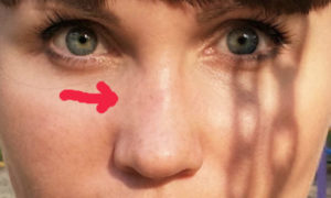 Опухает бок носа