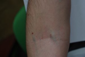 Шишка после взятия крови из вены