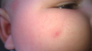 Прыщики на щеке у ребенка