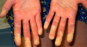 Боль при нажатии на кончики пальцев