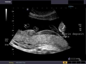 Множественные кисты и толстая плацента на 18 неделе беременности