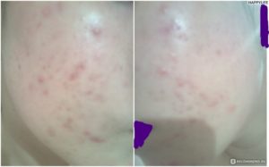 Появились прыщи при приеме Джес