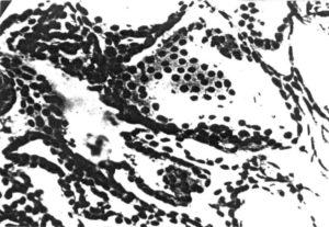 Пролиферация фолликулярного эпителия