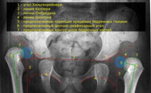 Дисплазия рентген расшифровка