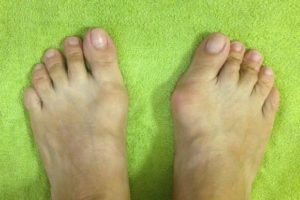 Выпирает косточка на одной стопе у ребенка