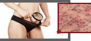 Зуд в интимной области при хорошем мазке