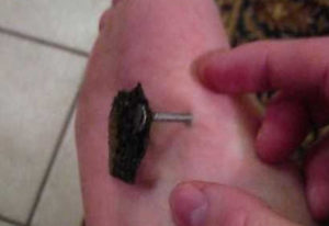 Проткнул отверткой Руку что делать