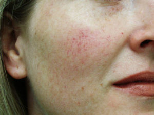 На щеках видны капилляры