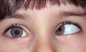 Глаз ушел внутрь