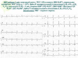 Экг ребенка 1 год
