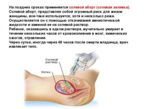 Медикаментозный аборт 10 недель