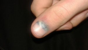 Прищемила палец дверью машины