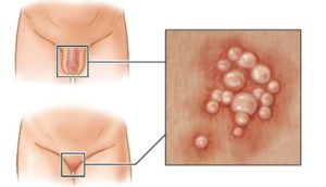 Высыпания на вульве