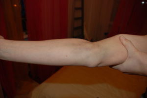 Шишка после взятия крови из вены