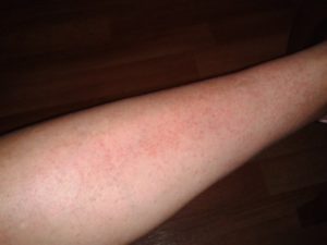 Чешутся ноги после душа