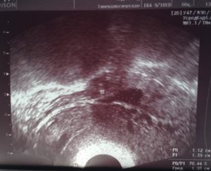 Жидкость в позадиматочном пространстве в первой половине цикла