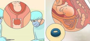 Выделения после установки пессария