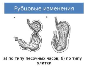 Желудок по типу песочных часов