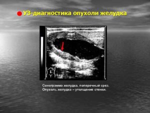 Утолщение стенок желудка