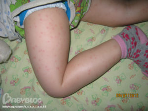 Сыпь на попе и ногах ребенка