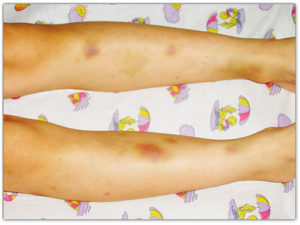 Острый лейкоз, синяки на теле без причины