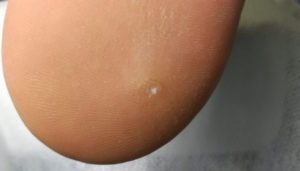 Образования типа мозолей между ягодиц