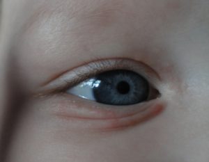 Белый прыщ на веке у ребёнка
