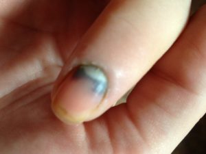 Прищемила палец дверью машины