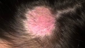 Стригущий Лишай, на его месте маленький прыщ