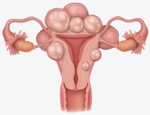 Онкомаркеры, миома матки, аденомиоз