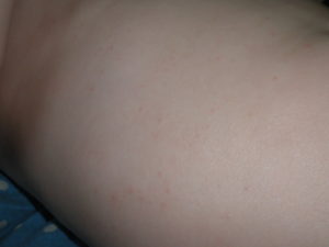 Сыпь чуть ниже груди у ребенка 12 лет