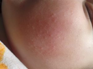 Прыщики на щеке у ребенка