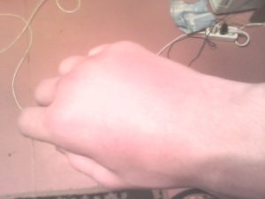 Помогите! Выбил казанок на правой руке мизинца