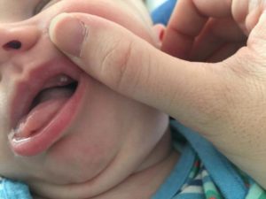 Белые бугорки на десне