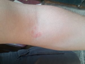 Пятна на сгибах рук