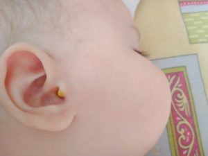 Засохшие комочки в ушке у ребенка