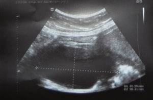 Множественные кисты и толстая плацента на 18 неделе беременности