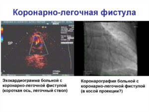 Коронарная фистула диагноз у ребенка