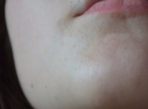 Бесцветная сыпь на лице