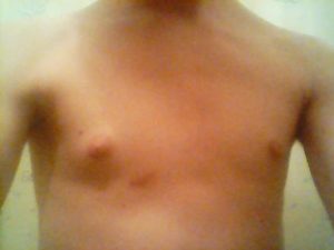 Шишка под правой грудью