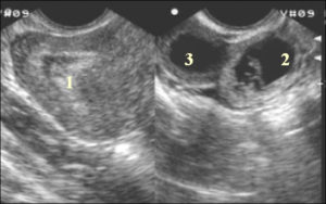 Жёлтое тело 16мм, эндометрий 8 при беременности