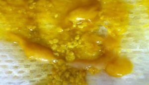 Частый Слизистый стул с белыми комочками на ИВ